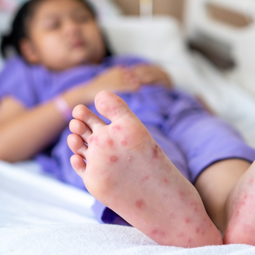 高雄國小腸病毒群聚，醫護父母隱瞞孩子疫情硬是到校考試，疫調又未吐實，依法重罰12萬元