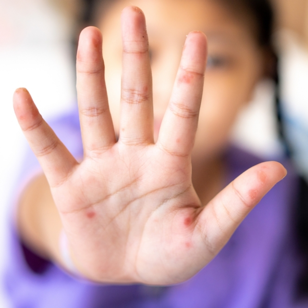 高雄某國小驚爆腸病毒群聚感染， 家長群怒控隱匿小孩病情未通報，堅持到校