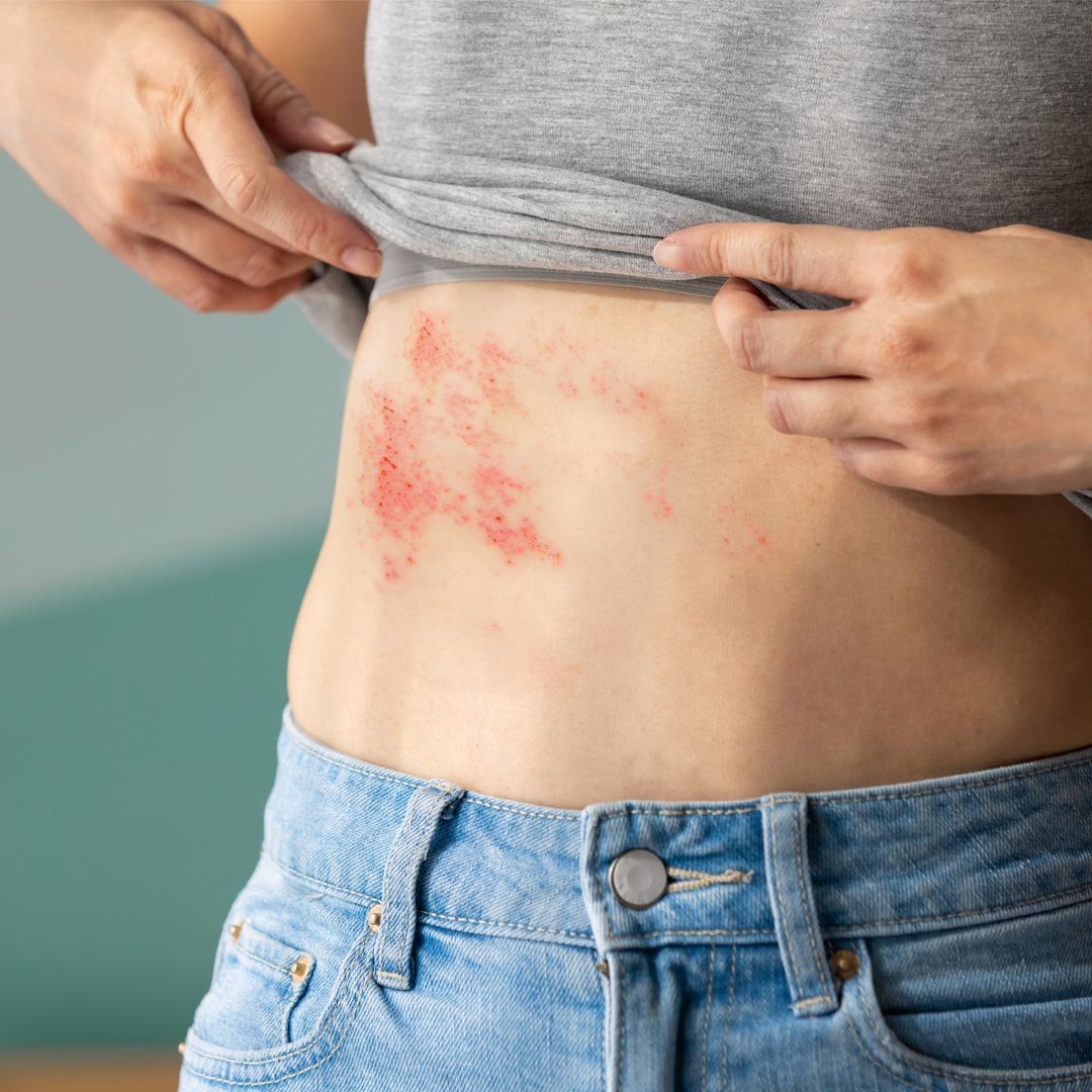 婦罹「皮蛇」輕觸就痛⋯醫揭癒後當心「1後遺症」恐致長期神經疼痛