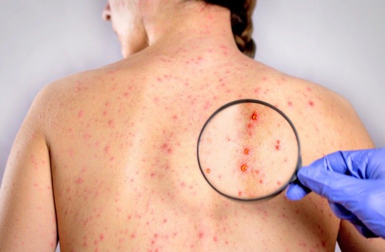 台北爆麻疹境外移入案！30歲男染病，捷運趴趴走383接觸者追蹤中，家長必知兒童防護足跡