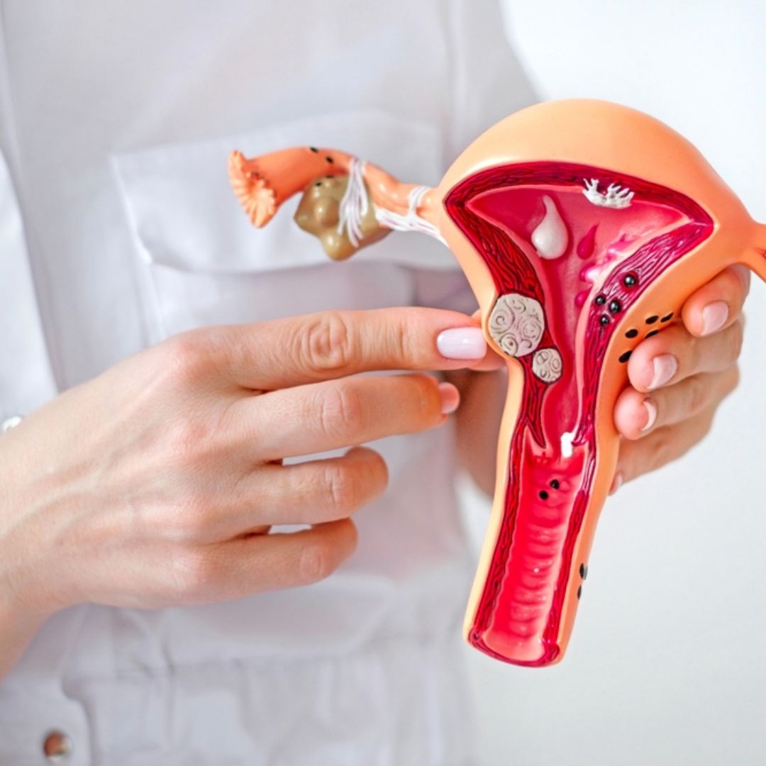 子宮肌瘤讓你經血過多嗎？新一代口服子宮肌瘤用藥上市，連續服用 4 週經血量降約六成