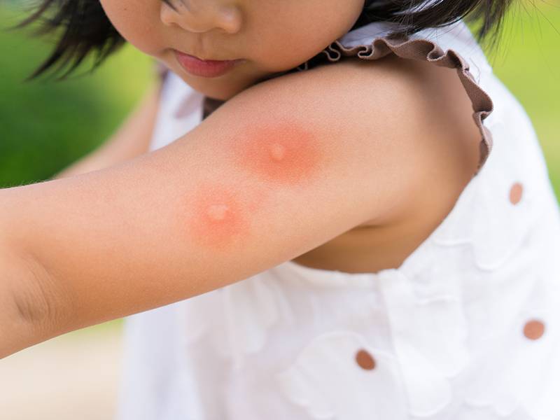夏天來臨，小心可怕吸血蟲，被叮咬時立刻使用肥皂沖洗，避免傷口感染！