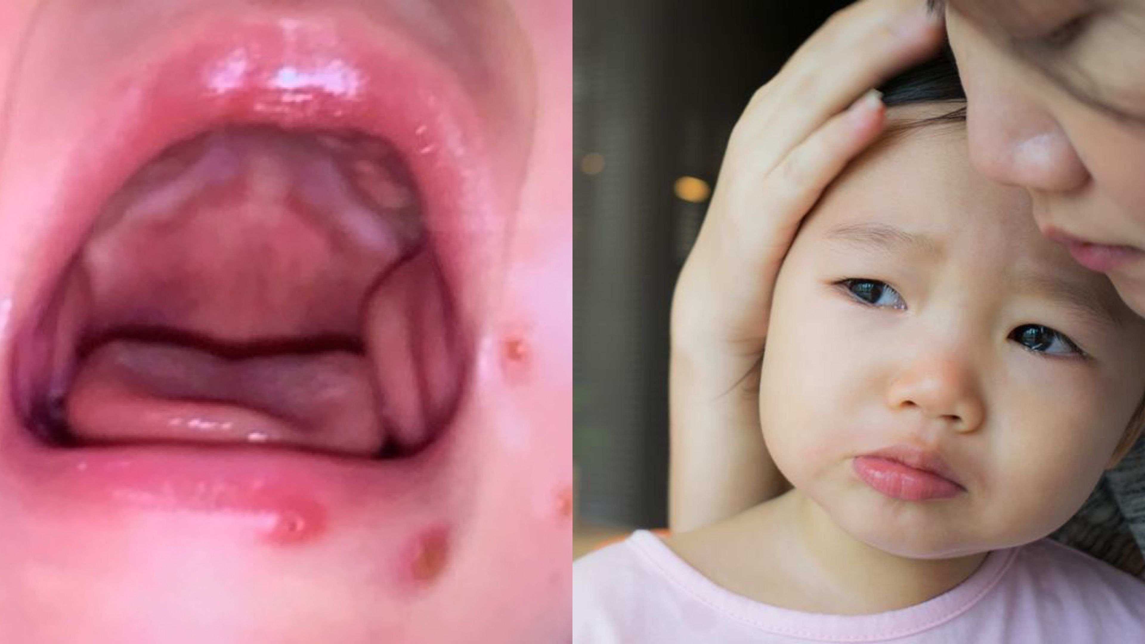 爸爸的吻有毒！造成雙胞胎兄弟高燒3天，送醫被診斷為「疱疹性齒齦舌炎」