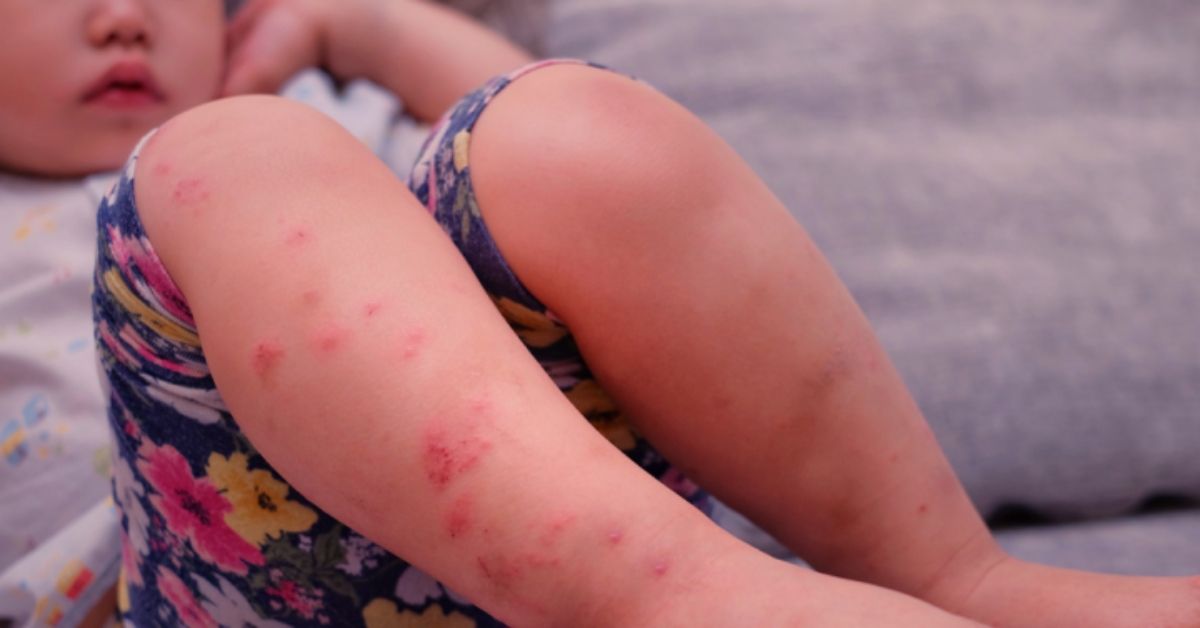 腸病毒疫情增溫！飆升16.5％ ，疾管署估6月將進入流行期