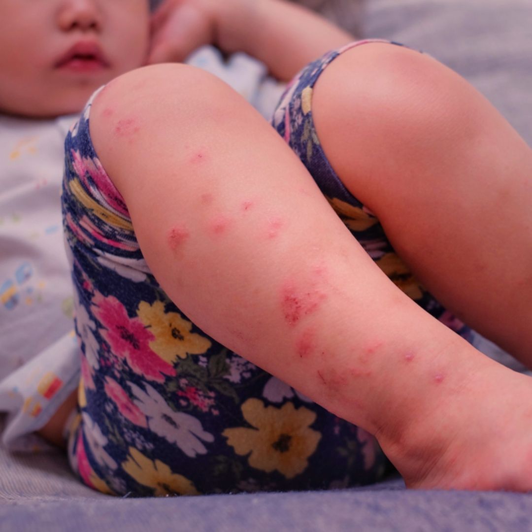 腸病毒疫情增溫！飆升16.5％ ，疾管署估6月將進入流行期