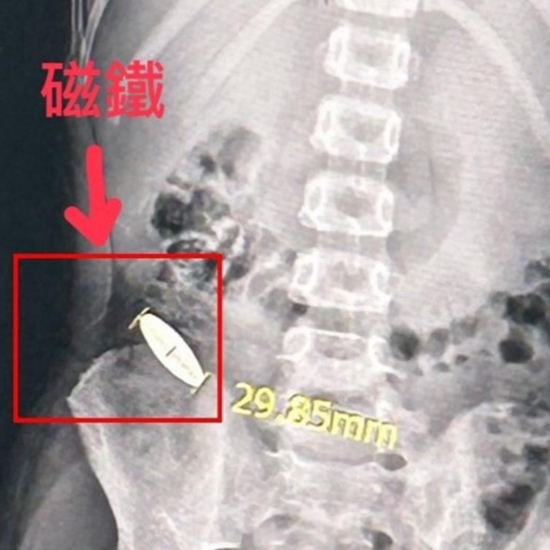 台南小一童遭霸凌逼「吞10元大小磁鐵」，補習班沒通報，男童肚子痛就醫才曝光