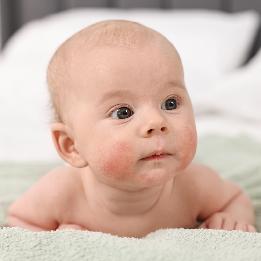 【長庚醫師團】從抓癢到好眠，破解兒童異位性皮膚炎的關鍵密碼！