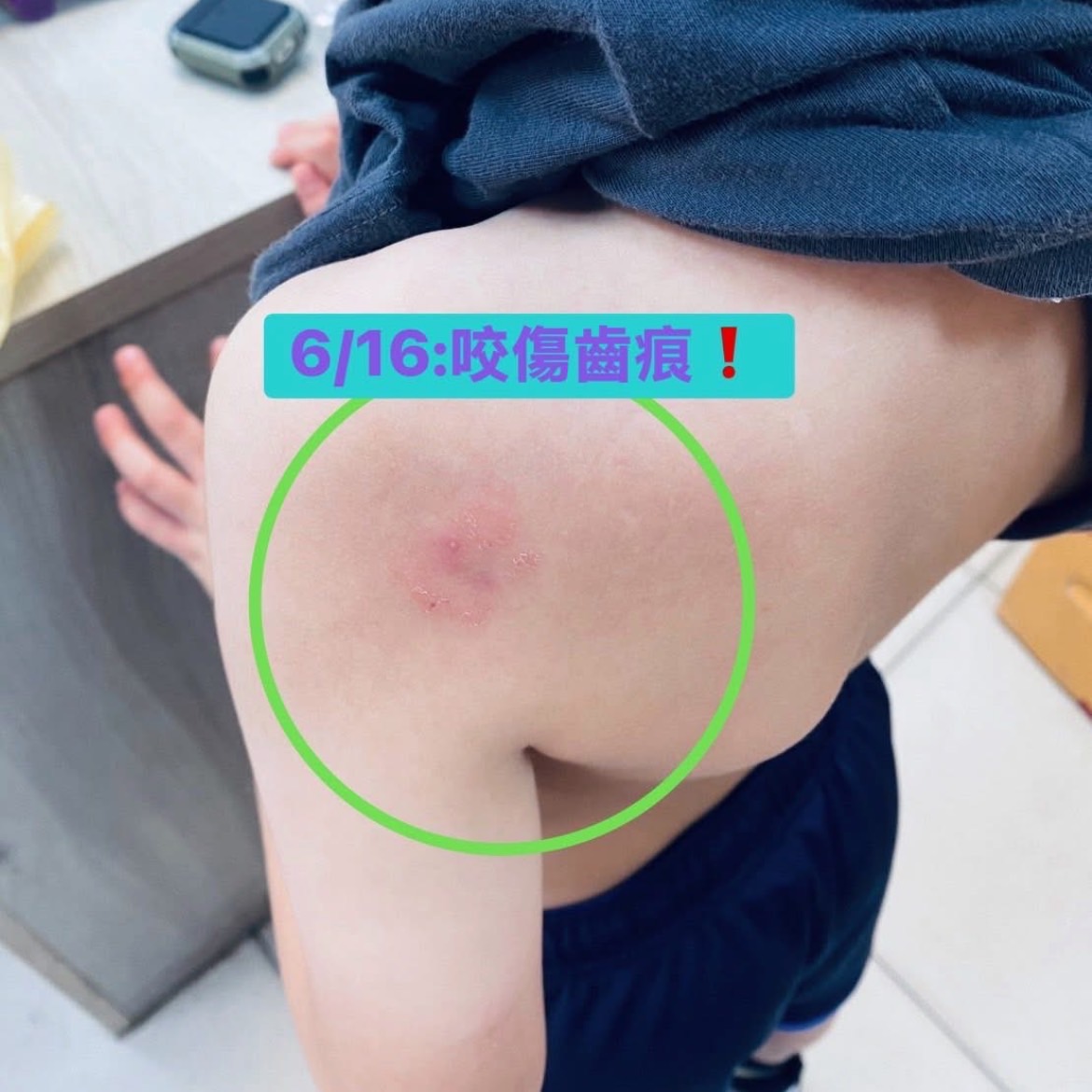 國小驚爆霸凌，男童三度被咬、頭撞腫，校方讓被害者「自己轉班」！家長無力說道：我已經不知道如何保護孩子