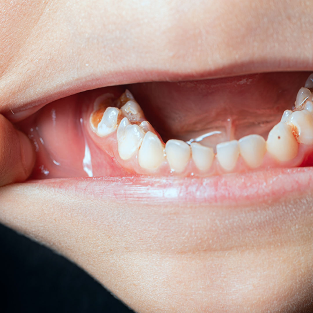 每天刷牙還是蛀！6歲女童8顆爛牙，醫師揪關鍵：少了這一步防線