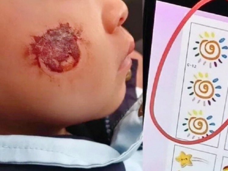 網購貼紙超毒？3歲女童幼兒園貼一下，臉部紅腫冒水泡，醫揭恐怖真相爸媽請筆記