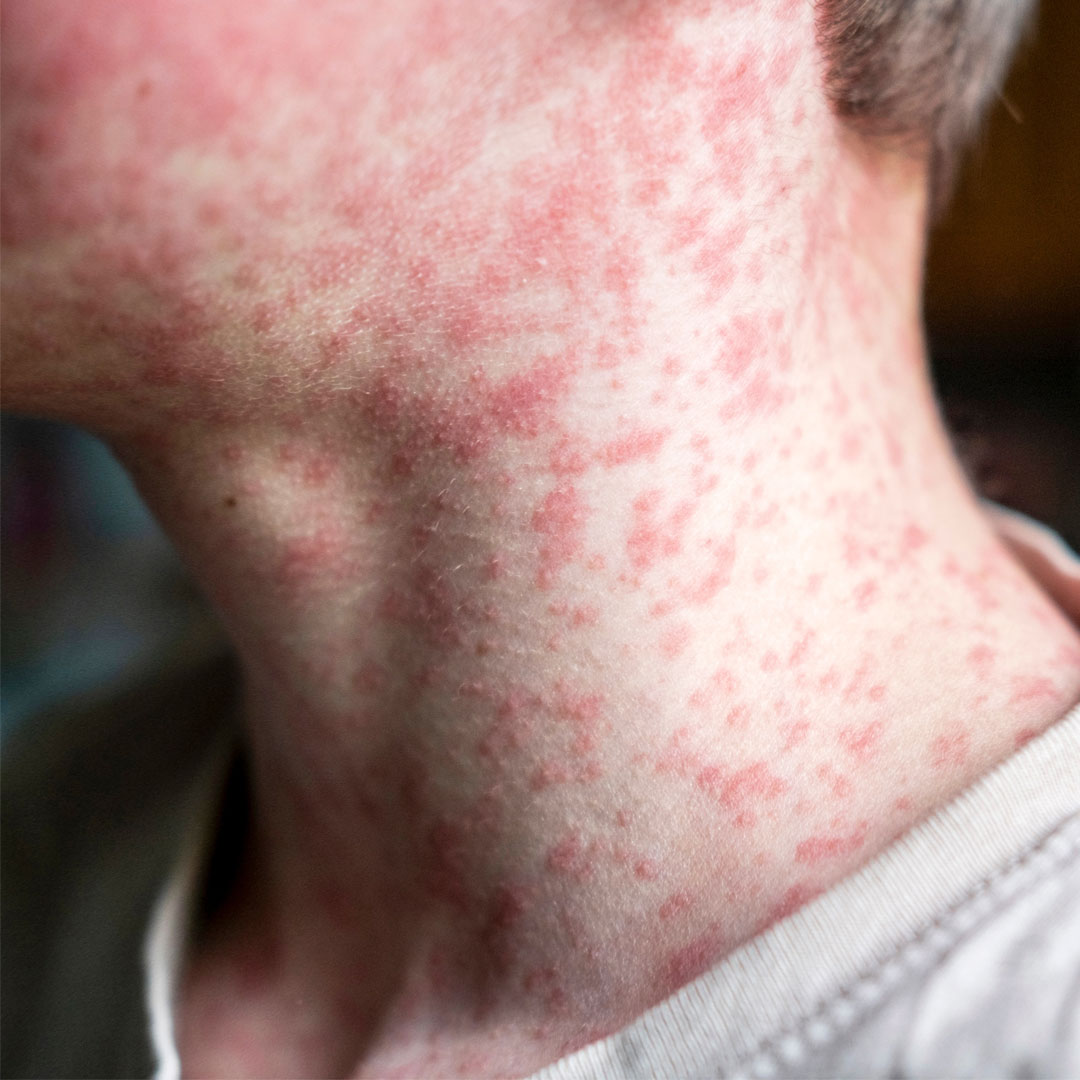 麻疹症狀有哪些？出現1症狀與感冒最不同：外觀如「鹽粒灑在紅肉上」
