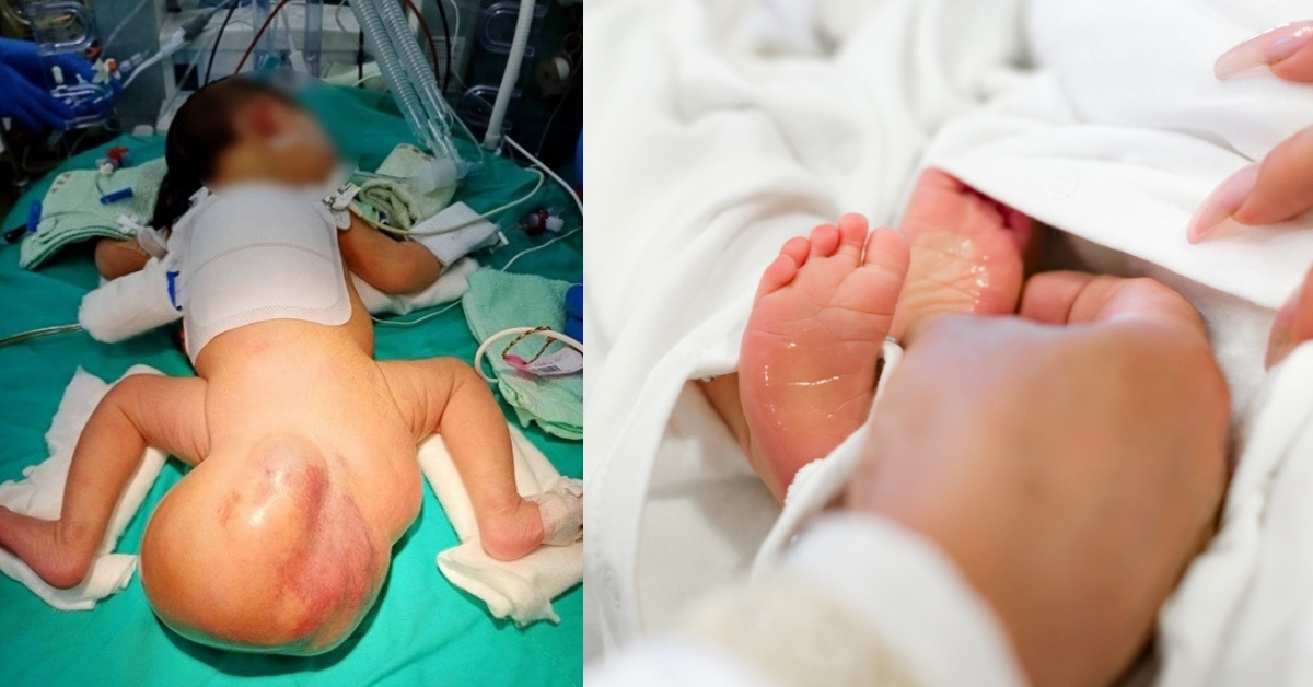 初生女嬰臀部連著罕見超大畸胎瘤，短短10週內暴增至16公分
