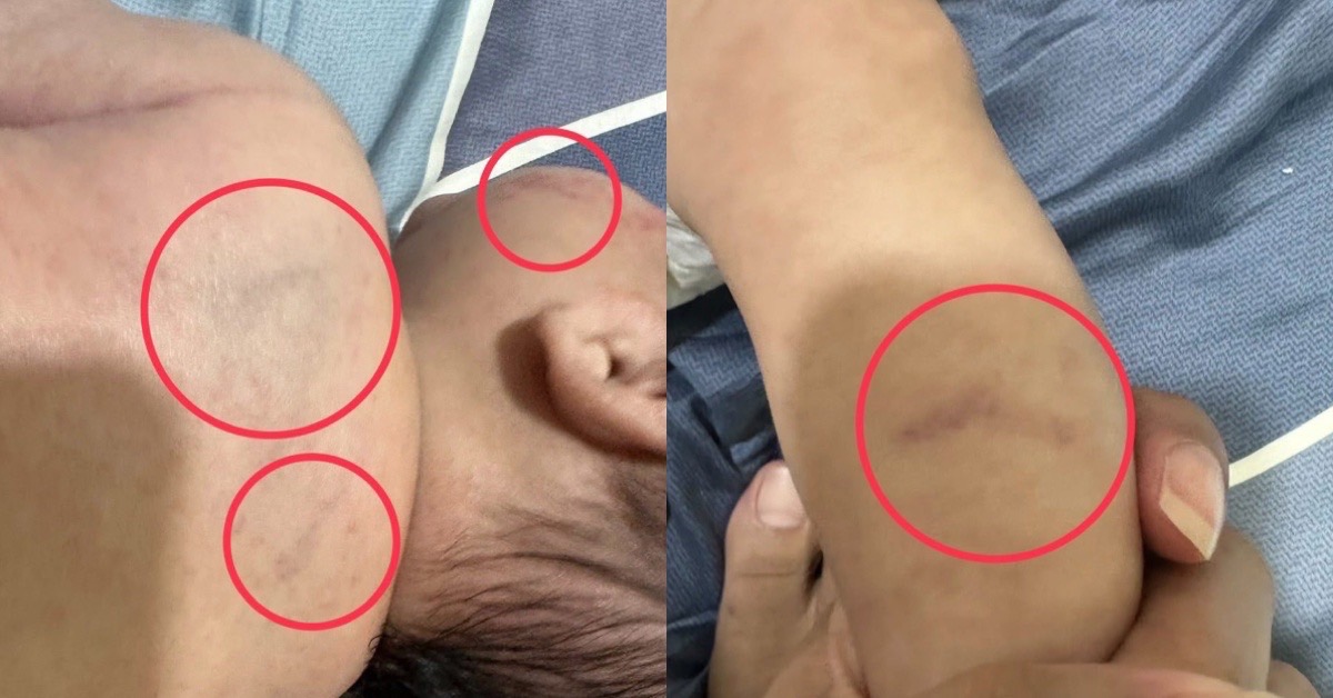 護理師背景竟成假象！桃園一名保母疑虐童，幼兒滿身瘀青，家長痛心控訴：「我們曾經那麼信任她！」