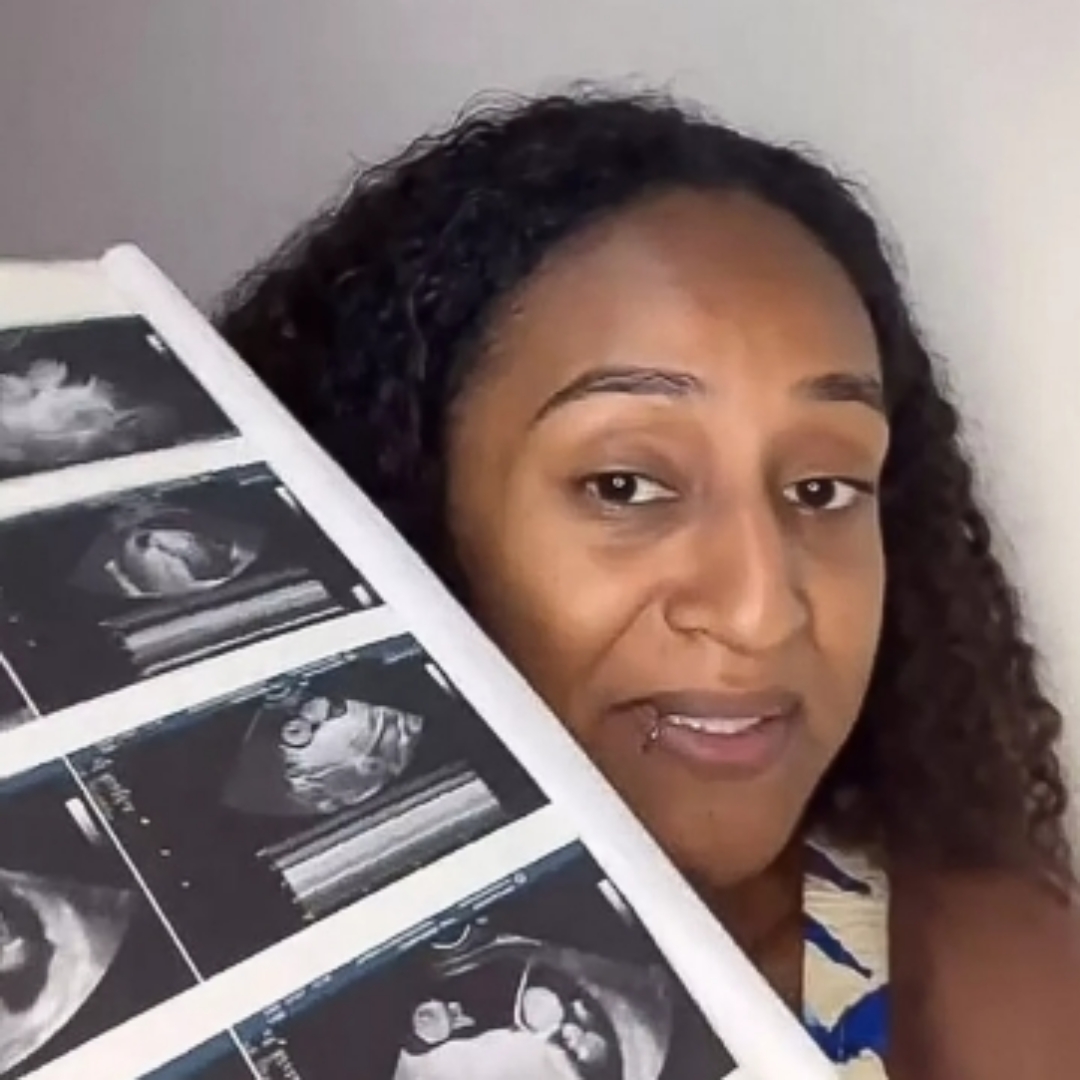 巴西媽媽罕見「異期雙胞胎」案例！生產更驚險，先自然產，另一胎剖腹產　