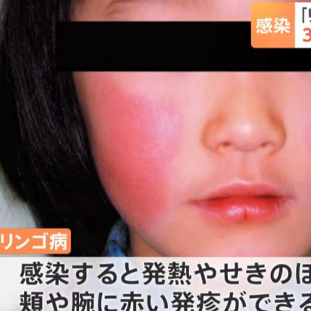 臉頰通紅注意！日本爆「蘋果病」酒精無法消滅 專家認證「2方法」才可預防