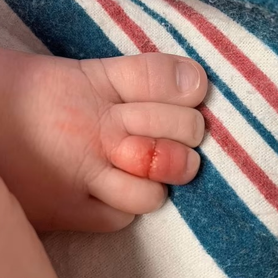 小心頭髮！嬰兒因「頭髮止血帶症候群」差點截肢！家長請注意三大常見纏繞部位