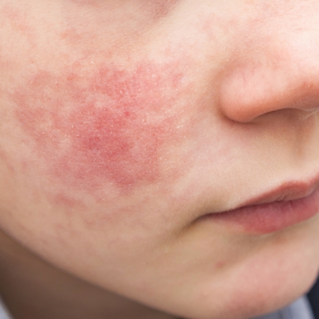 遊日回國，孩子出現「蘋果臉」，先是感冒與低燒，醫師提醒可能是這疾病