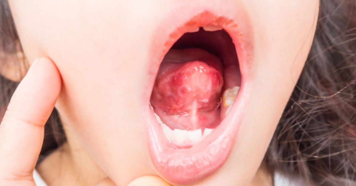 孩子嘴巴破洞！醫示警：要懷疑是不是腸病毒，這2處一定要檢查