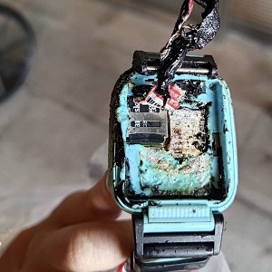 兒童智能手錶惹禍！突「爆炸自燃」男童右手臂2度燒燙傷恐需植皮