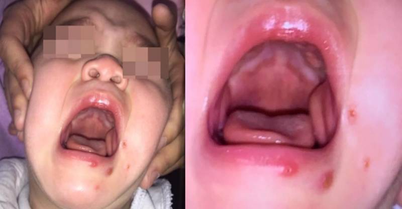爸爸的吻有毒！造成雙胞胎兄弟高燒3天，送醫被診斷為「疱疹性齒齦舌炎」