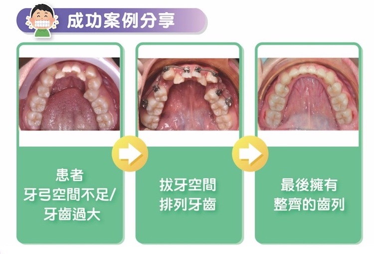 兒童牙齒凌亂怎麼辦？牙醫建議三大常見解決方法