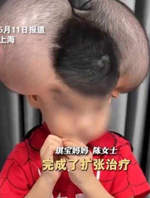 3歲男童頂「米奇頭」巨痣！琪寶與母親的抗痣之路令人動容，「我們不是天生堅強，是擦乾眼淚往前走出來的」