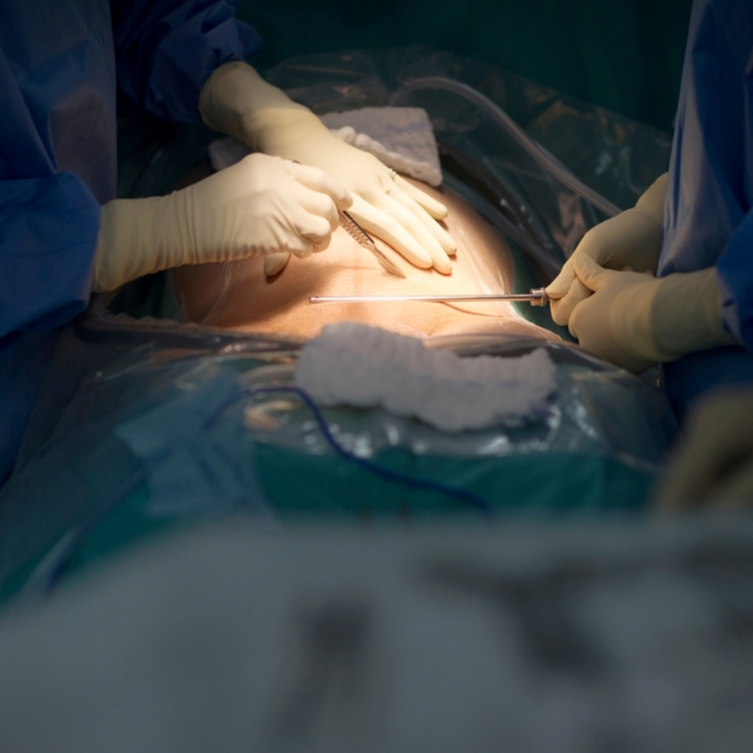 剖腹產注意事項一次看！術前準備、手術流程到術後照護完整解析