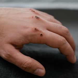 蠶豆症患者應避免使用「液體OK繃」，樟腦成分會造成「溶血反應」嚴重副作用