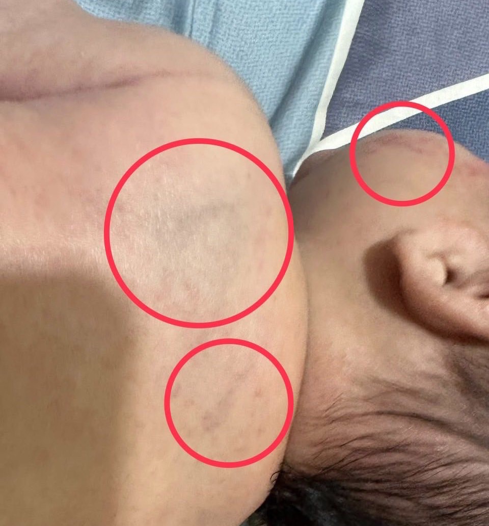 護理師背景竟成假象！桃園一名保母疑虐童，幼兒滿身瘀青，家長痛心控訴：「我們曾經那麼信任她！」