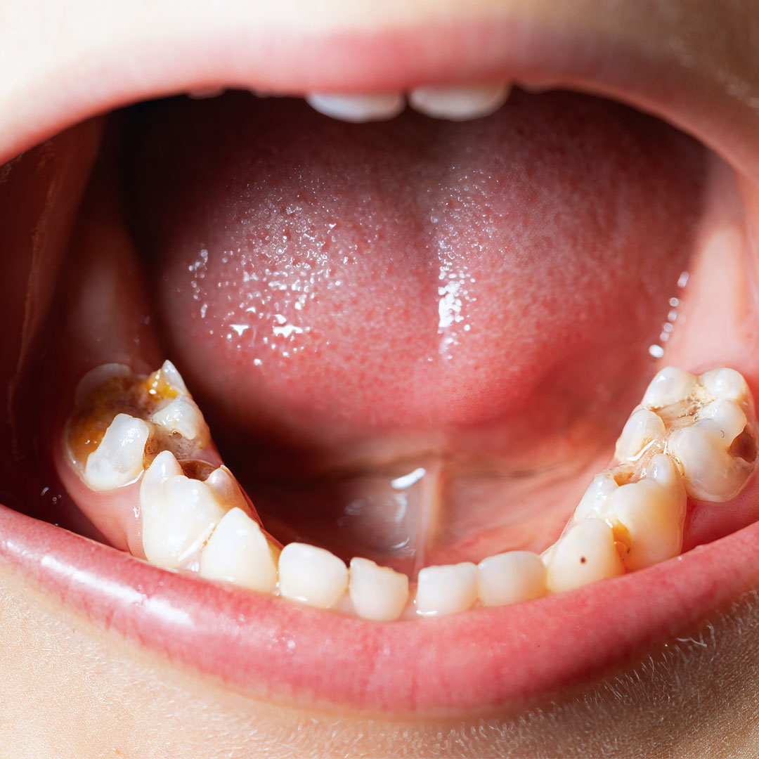 為何每天刷牙還是蛀牙？醫揭關鍵原因：少做「這一步」，牙刷再勤也難敵蛀牙侵襲