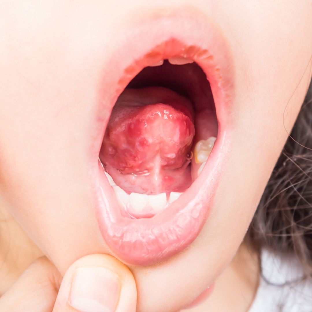 孩子嘴巴破洞！醫示警：要懷疑是不是腸病毒，這2處一定要檢查