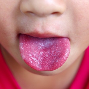 草莓舌別輕忽！最常見是這兩種疾病引起，一定要及時治療