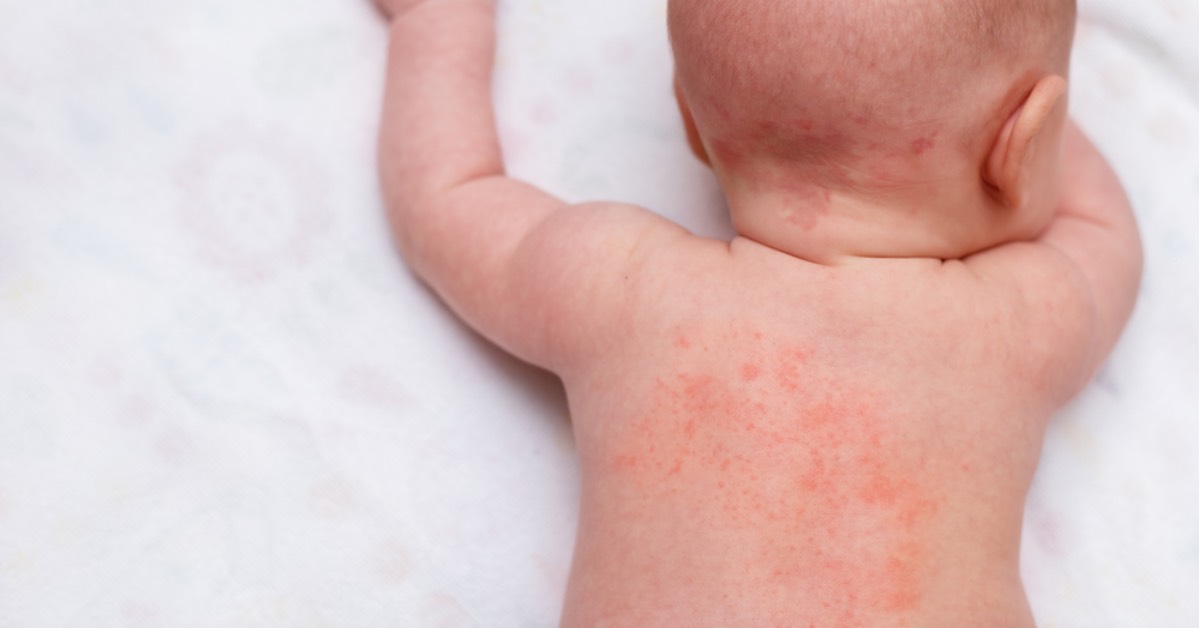 夏日寶寶皮膚常見5大問題：熱疹、異位性皮膚炎！爸媽必知的解決方法｜Mombaby 媽媽寶寶懷孕生活網
