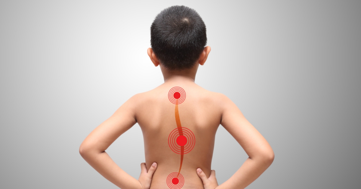 兒童脊椎側彎，早期沒有明顯不適，6個容易被忽略的警訊，請每3～6個月幫孩子初步檢查