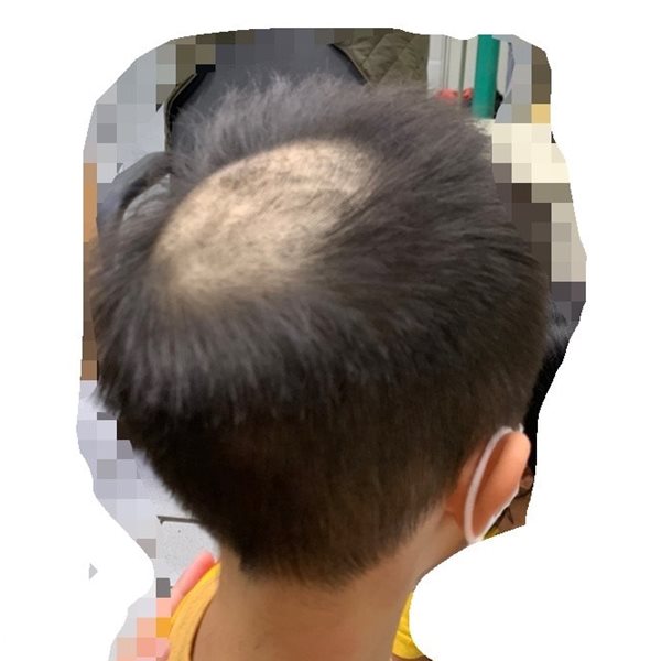 看到孩子採集毛髮頭皮都禿了！媽媽好心痛，「看到孩子受這樣的苦痛，就會覺得不能這樣就算了」