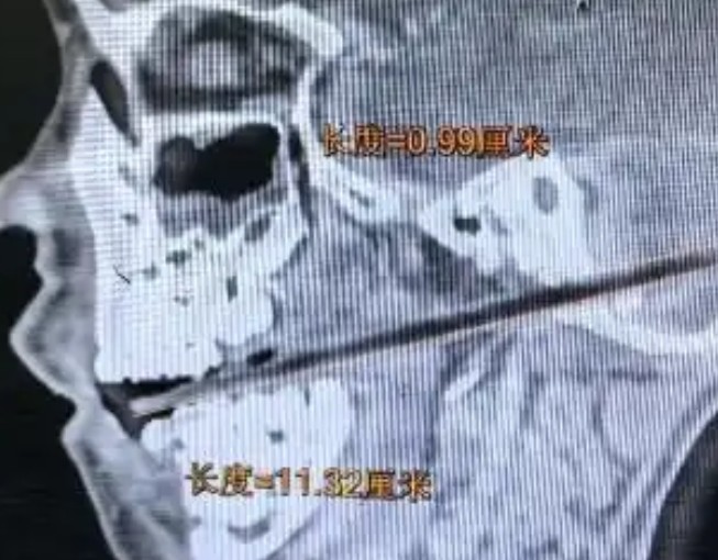 6歲男童邊走邊吃麥芽糖跌倒！竹籤從「口腔刺到顱底」，長達12公分，直接貫穿至顱底，深入小腦區域。