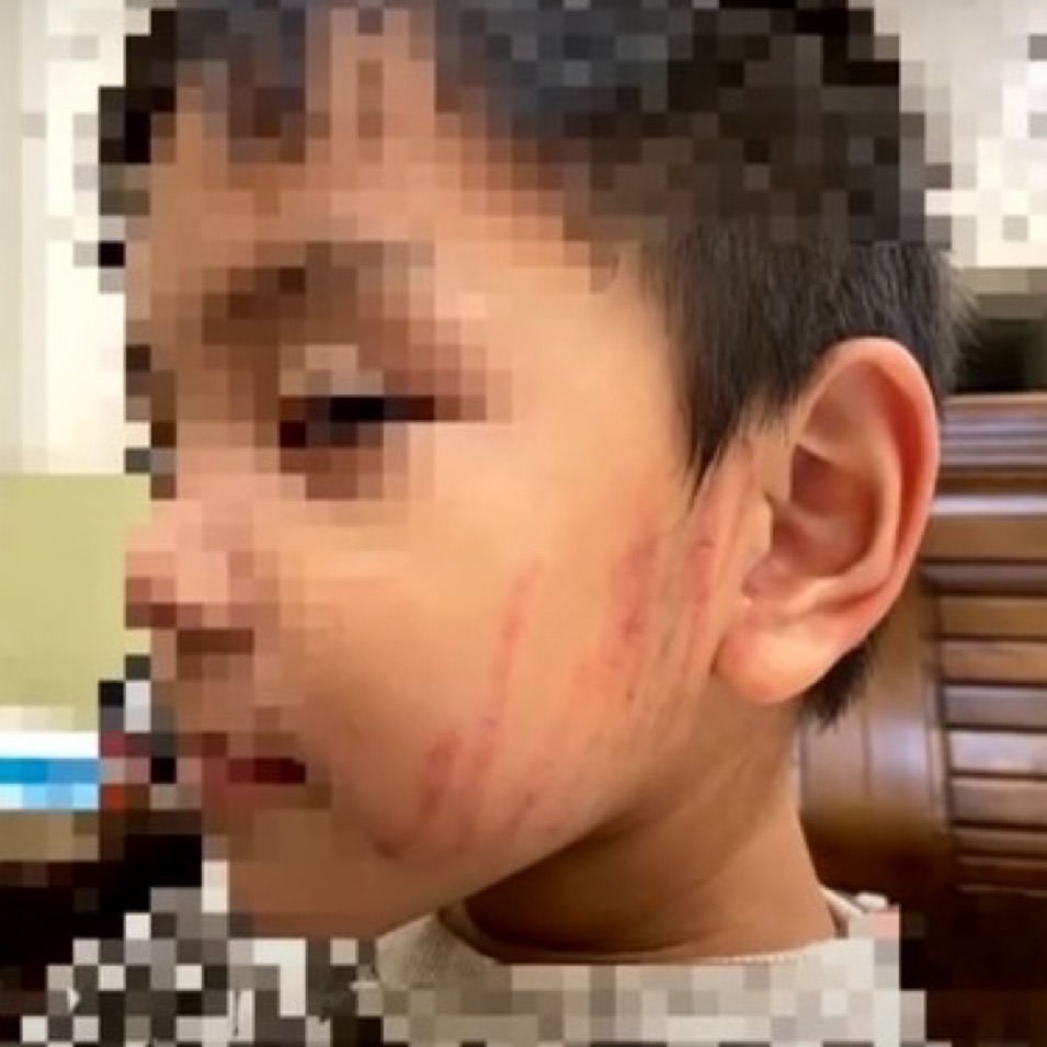 4歲男童抓傷同學臉，幼保員反抓傷男童：我要讓他體驗被抓的感覺！這一舉動觸法不當管教