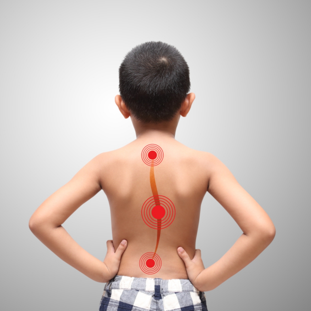 兒童脊椎側彎，早期沒有明顯不適，6個容易被忽略的警訊，請每3～6個月幫孩子初步檢查