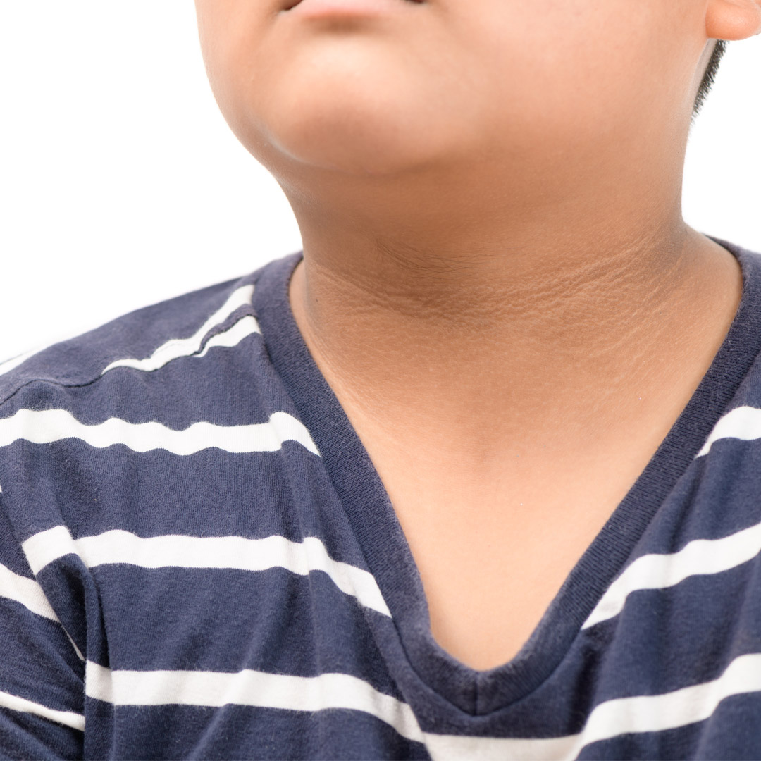 孩子脖子黑黑的⋯是沒洗乾淨嗎？兒科醫揪「黑棘皮症」好發肥胖兒童