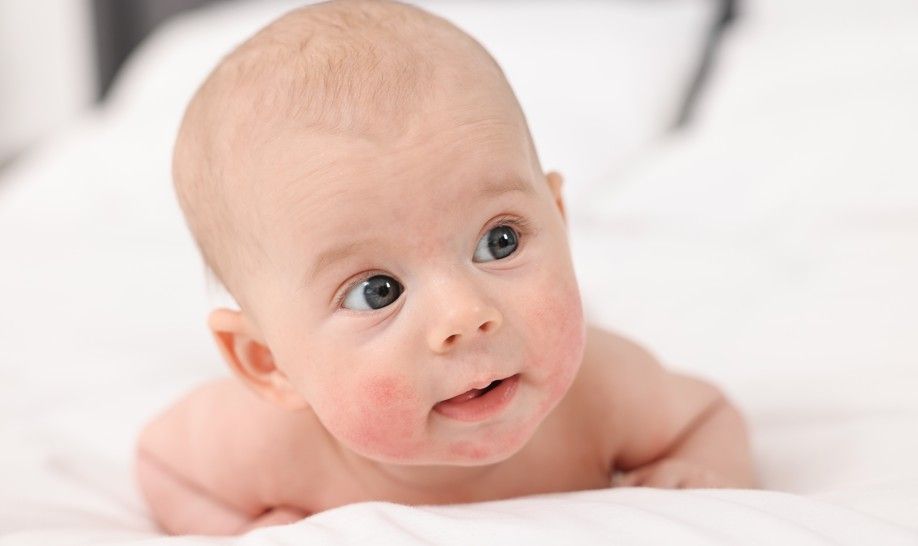 寶寶紅疹