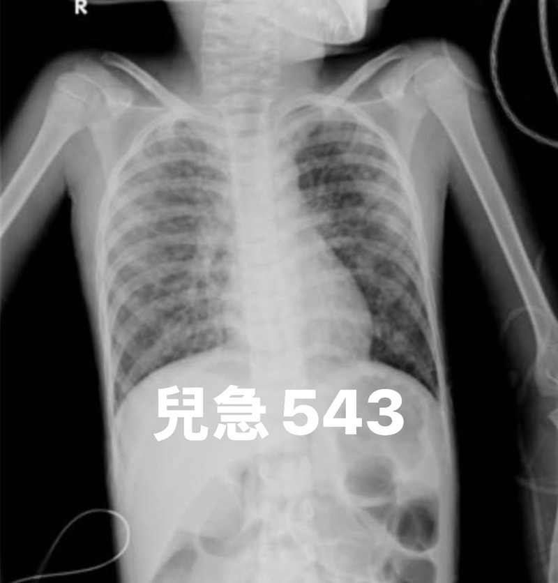 水痘|氣喘|男童|水痘病毒|類固醇|重症|兒童加護病房|兒童急診|醫師