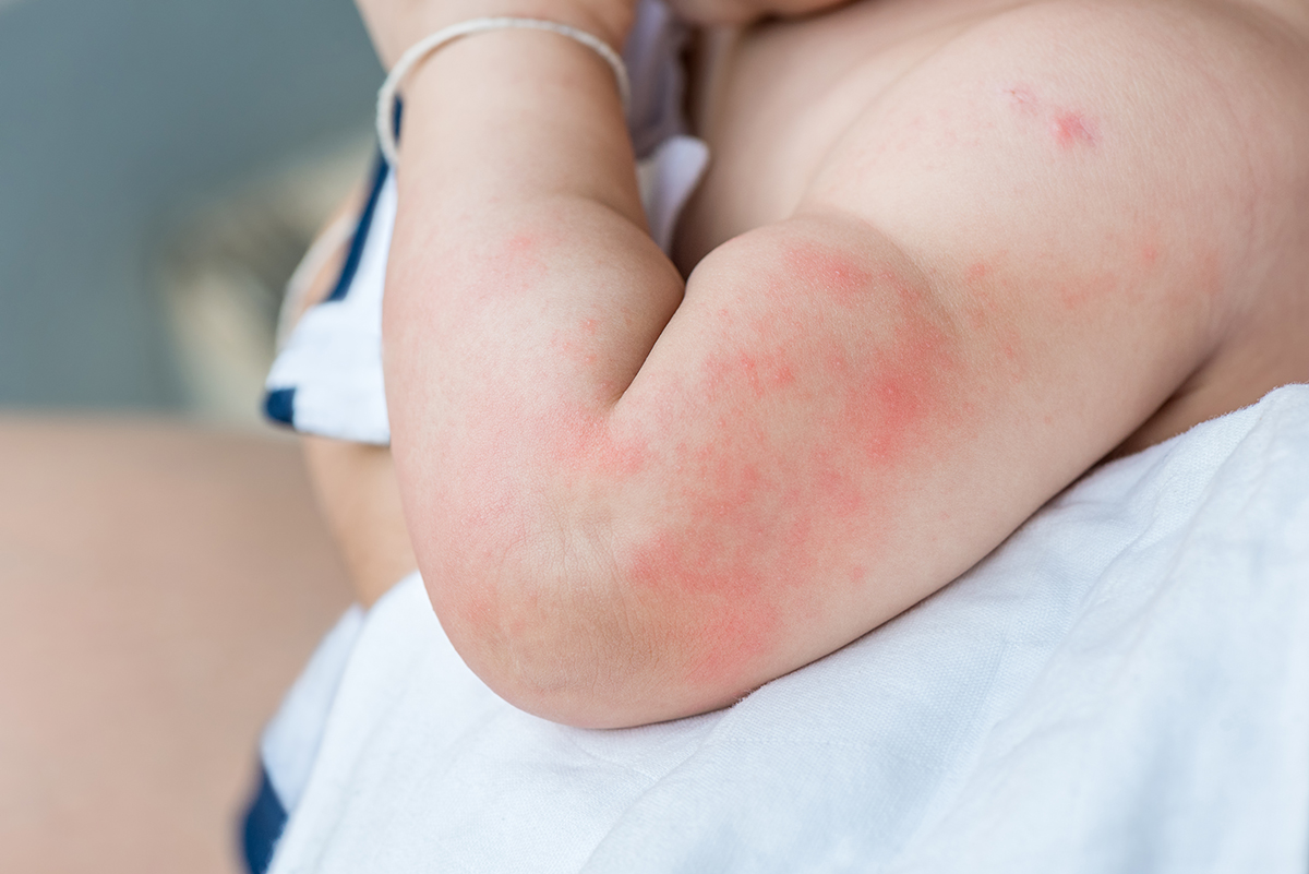 寶寶疹子分辨｜嬰兒紅疹｜幼兒紅疹｜嬰兒皮膚紅疹