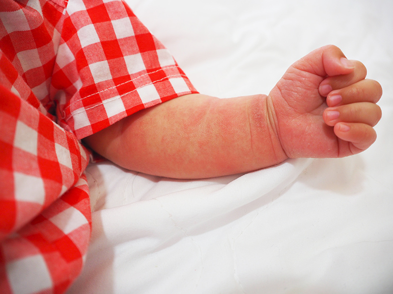 小煜 |異位性皮膚炎 |嬰幼兒肌膚照顧