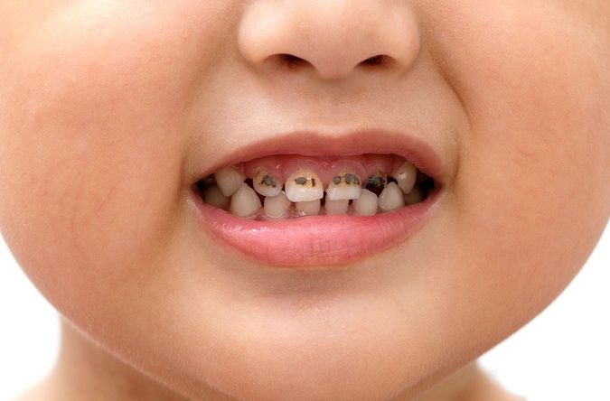 台灣5歲以下兒童近一半的幼童曾蛀牙