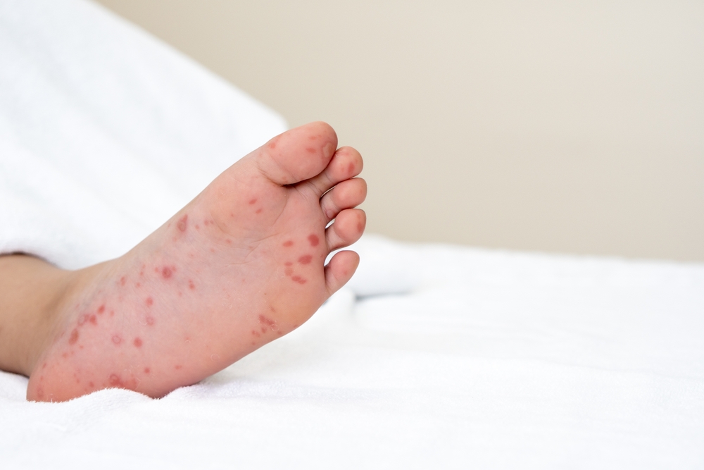 腸病毒│高雄│群聚