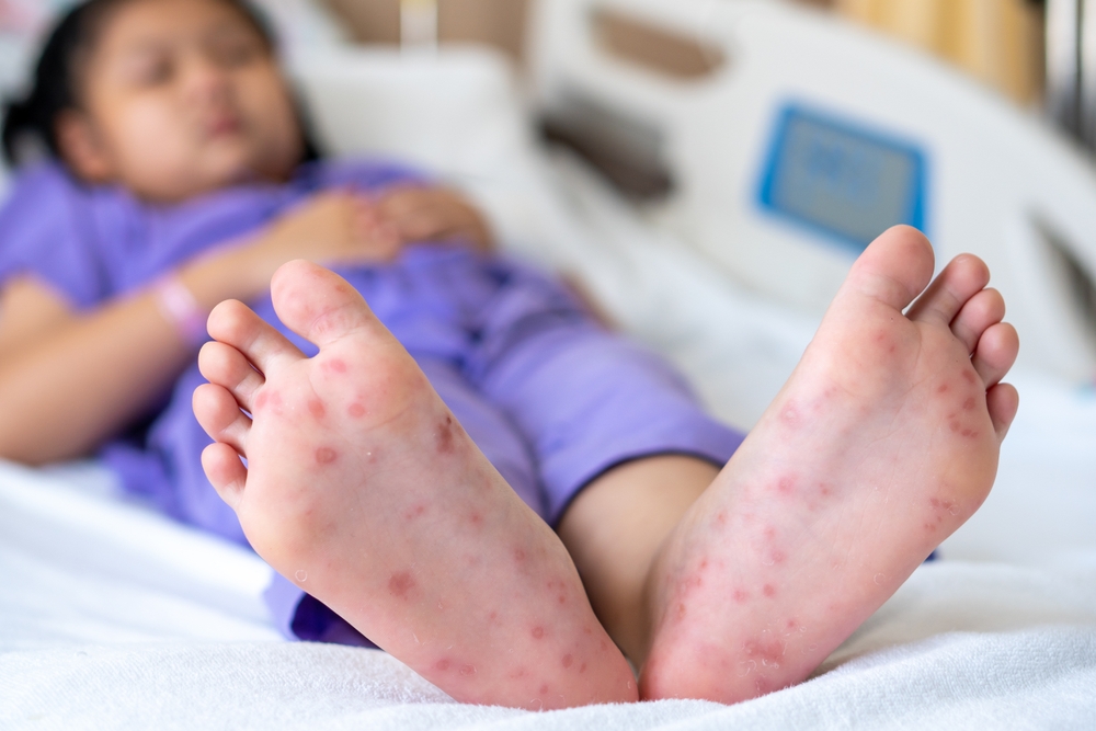 腸病毒│高雄│群聚