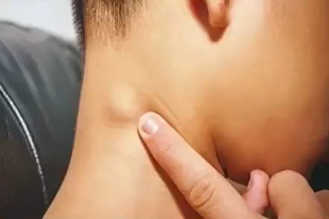 神經母細胞瘤