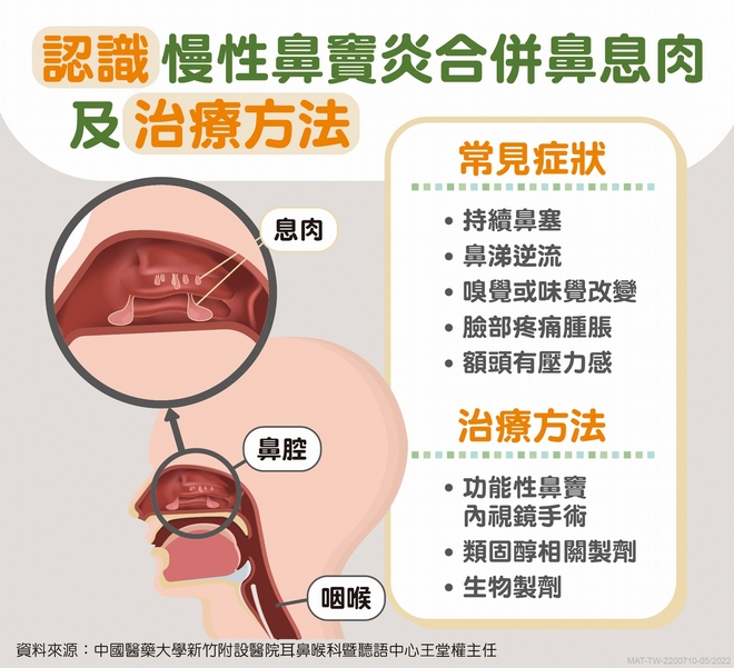 慢性鼻竇炎│鼻息肉