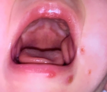 疱疹性齒齦舌炎