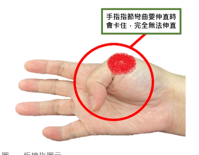 板機指│手指屈指肌腱狹窄性腱鞘炎